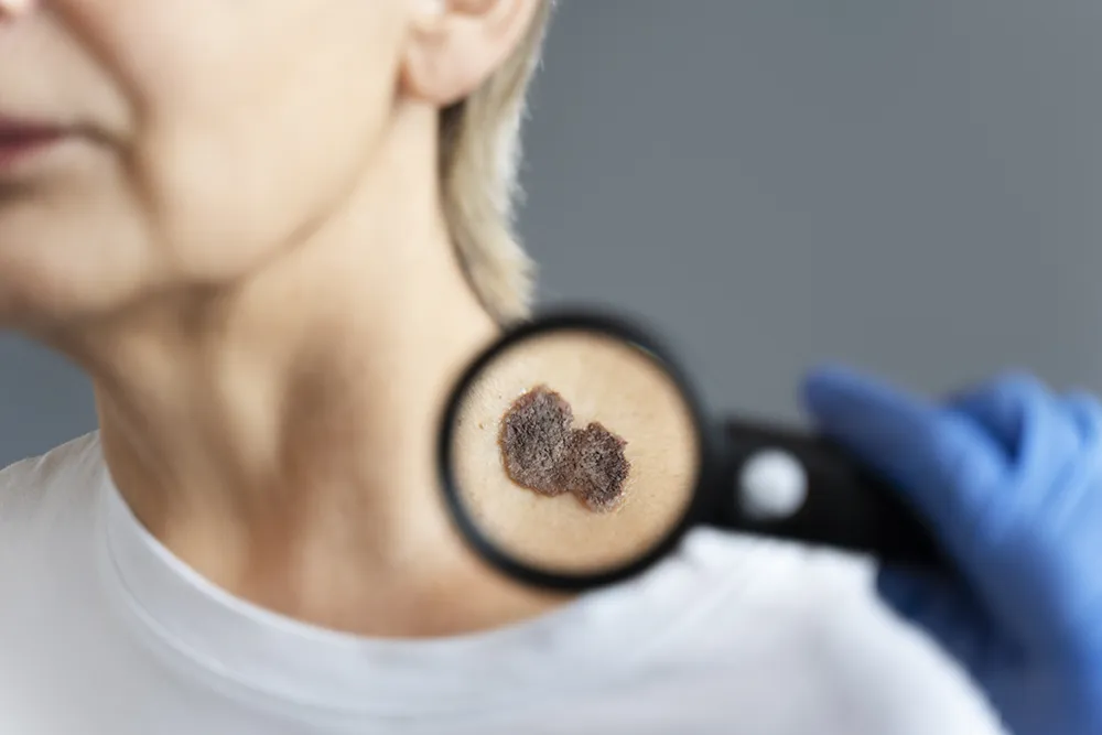 Nódulo de tireoide hiperfuncionante em exame